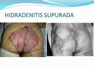 HIDRADENITIS SUPURADA
 