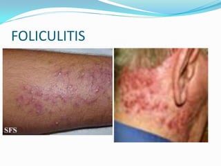 FOLICULITIS
 
