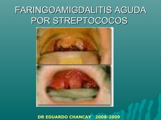 FARINGOAMIGDALITIS AGUDAFARINGOAMIGDALITIS AGUDA
POR STREPTOCOCOSPOR STREPTOCOCOS
DR EDUARDO CHANCAY 2008-2009
 