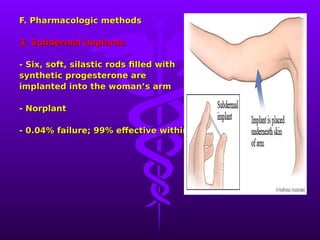 Silastic Application Method Comprehensive Guide to Family Planning and Contraceptive Methods | PDF