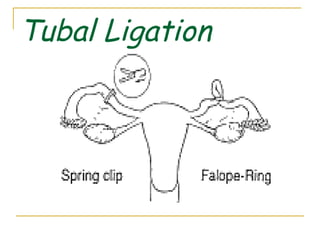 Tubal Ligation
 