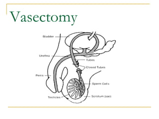 Vasectomy
 