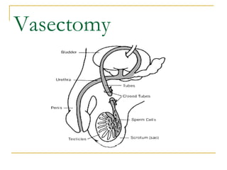 Vasectomy 