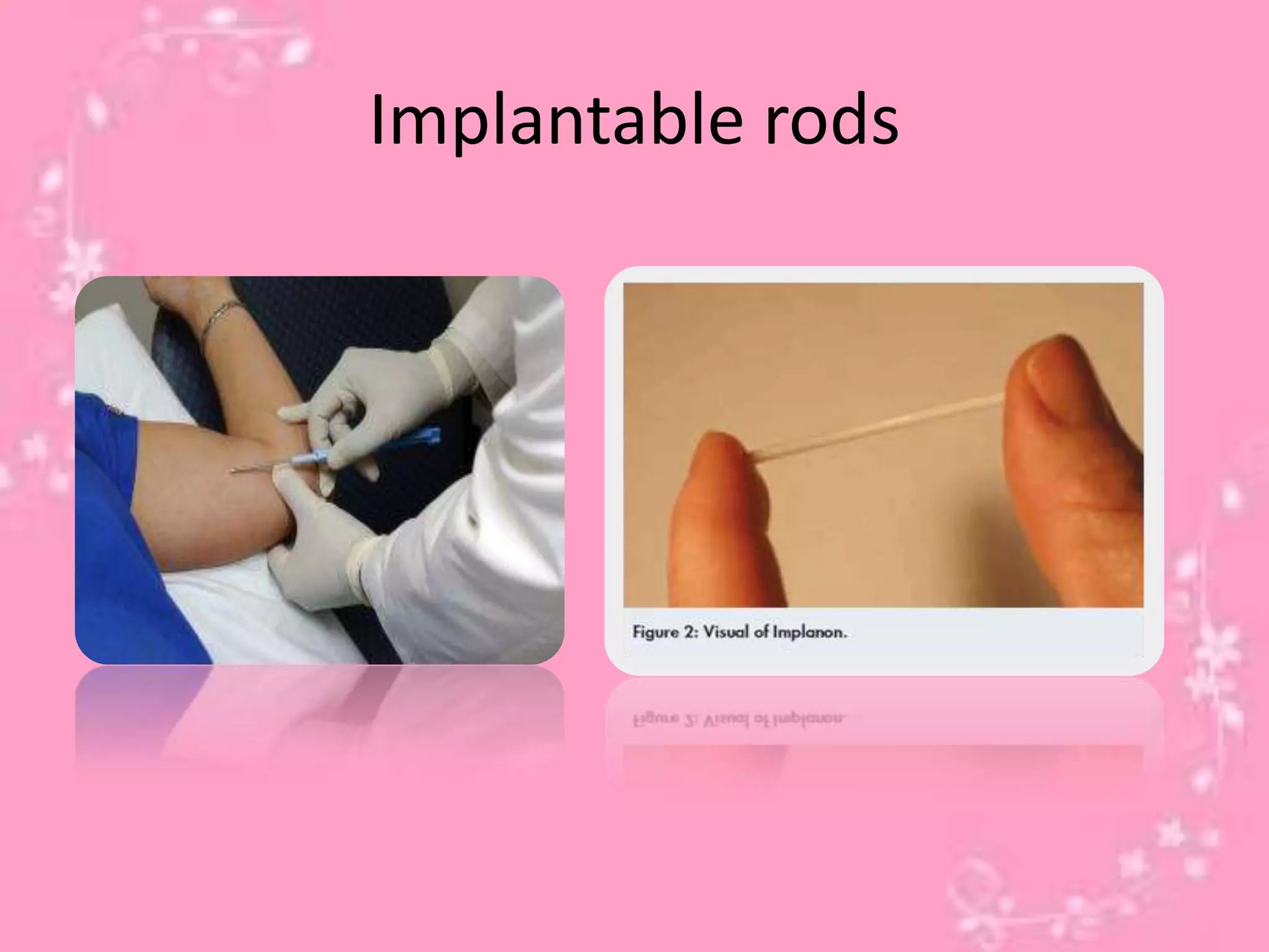 Implantable rods