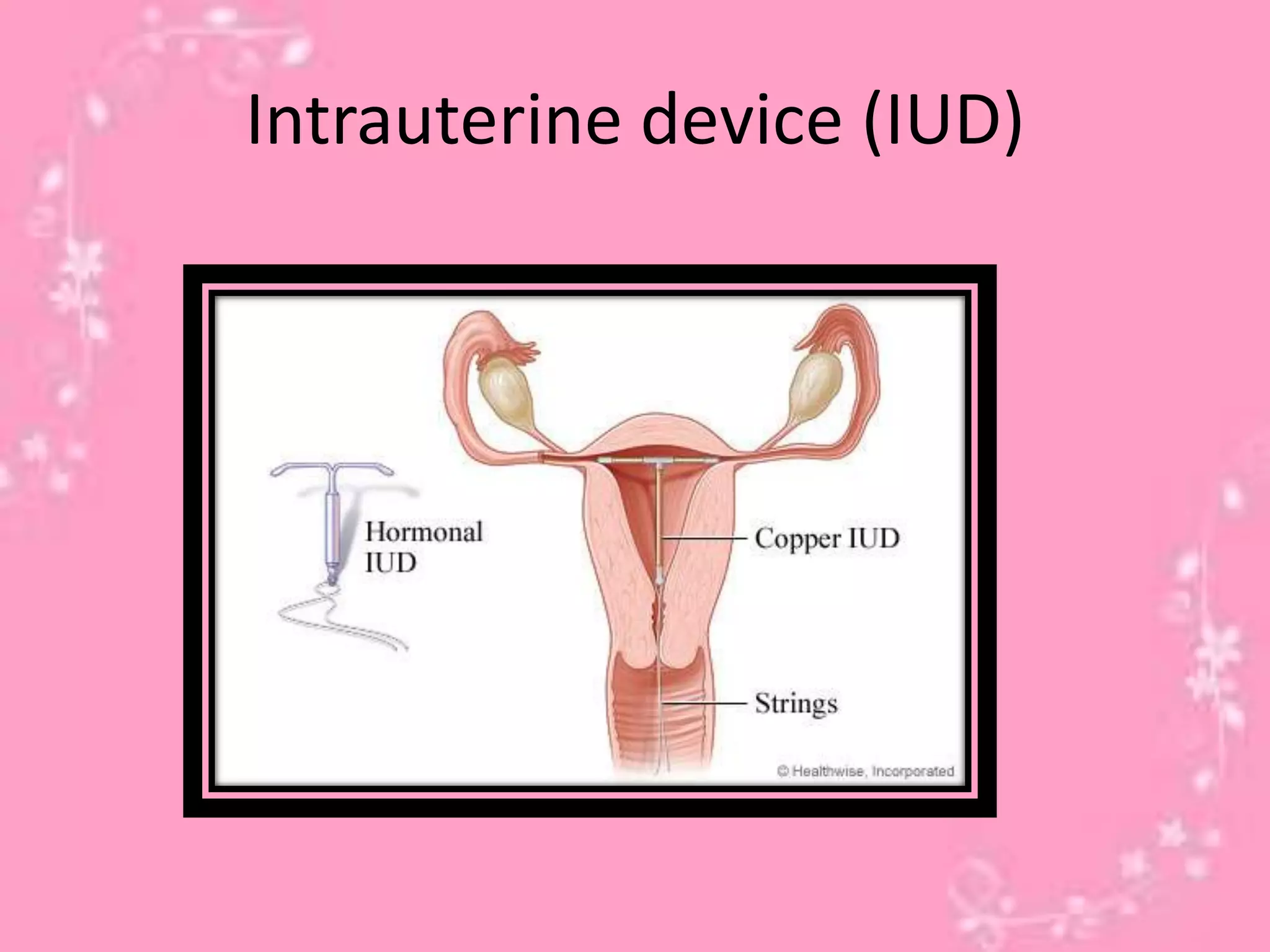 Intrauterine device (IUD)