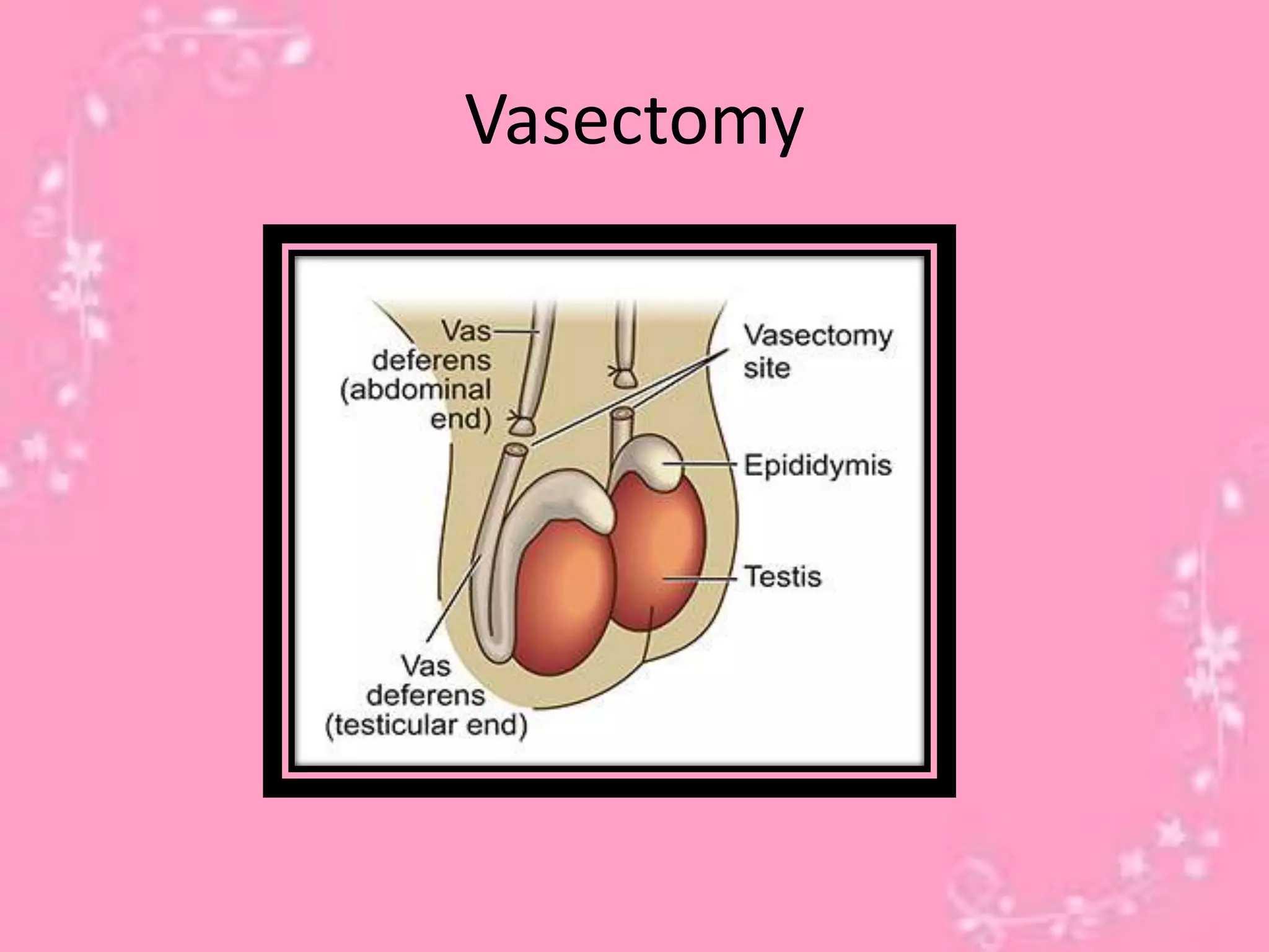 Vasectomy