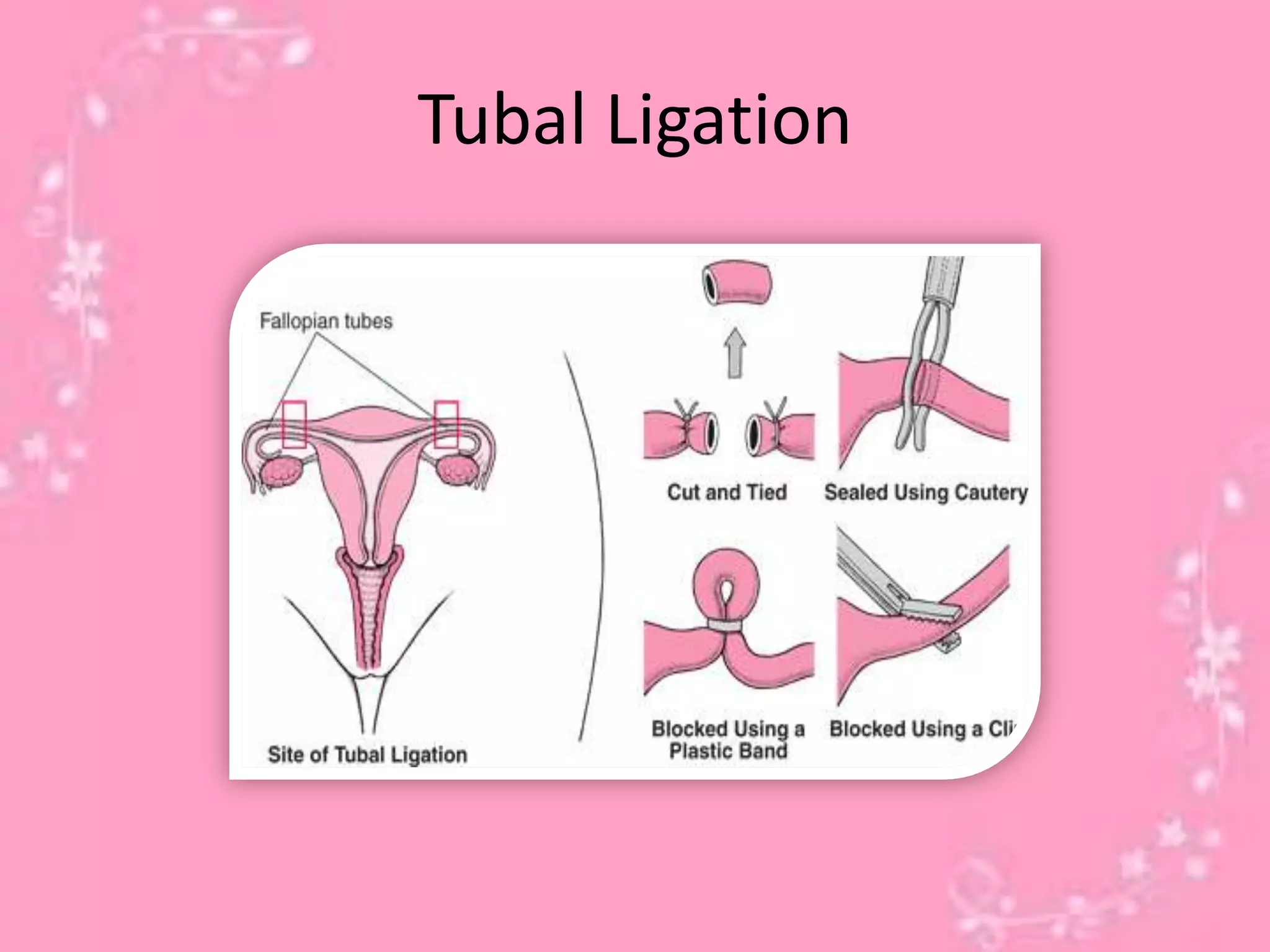 Tubal Ligation