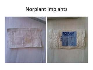 Norplant Implants

 