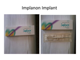 Implanon Implant

 