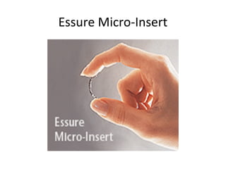 Essure Micro-Insert

 