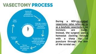 During a NSV-no-scalpel
vasectomy (also referred to
as a keyhole vasectomy), no
incisions are made.
Instead, the surgeon uses a
hemostat (locking forceps
with a sharp tip) to
puncture through the skin
of the scrotal sac.
 