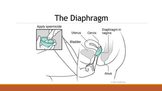 The Diaphragm
 