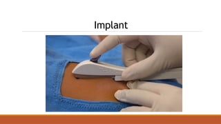 Implant
-Stimulate cell proliferation and fluid accumulation in the
breast tissue  breast fullness/tenderness
-Binds to androgen receptors in SCT  increased sebum
production  acne
-Asynchronous and unstable endometrial lining  menstrual
irregularities
 