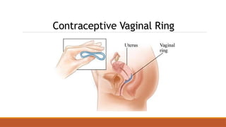 Contraceptive Vaginal Ring
 