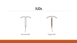 IUDs
 