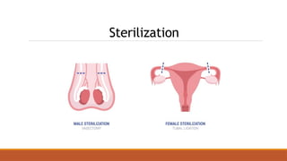 Sterilization
 