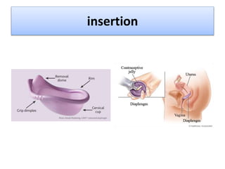 insertion
 