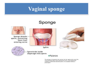 Vaginal sponge
 