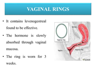 VAGINAL RINGS
• It contains levenogestreal
found to be effective.
• The hormone is slowly
absorbed through vaginal
mucosa.
• The ring is worn for 3
weeks.
 