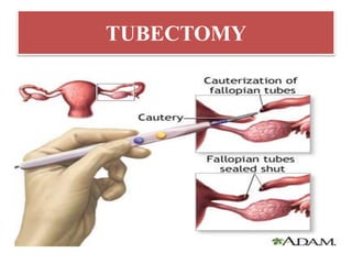 TUBECTOMY
 
