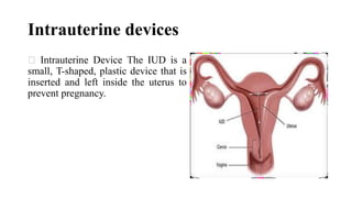 Intrauterine devices
Intrauterine Device The IUD is a
small, T-shaped, plastic device that is
inserted and left inside the uterus to
prevent pregnancy.
 