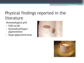 Physical findings reported in the
literature
Dermatological 40%
• Café au lait
• Generalized hyper-
pigmentation
• Hypo-pigmented areas
 