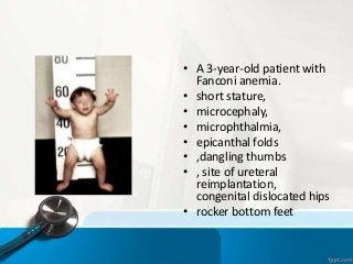 • A 3-year-old patient with
Fanconi anemia.
• short stature,
• microcephaly,
• microphthalmia,
• epicanthal folds
• ,dangling thumbs
• , site of ureteral
reimplantation,
congenital dislocated hips
• rocker bottom feet
 