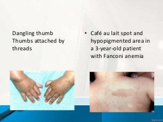• Café au lait spot and
hypopigmented area in
a 3-year-old patient
with Fanconi anemia
Dangling thumb
Thumbs attached by
threads
 