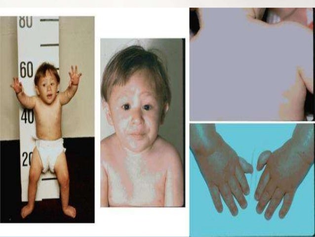 Fanconi anemia, syndrome