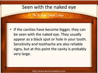 http://www.dentistcudahyca.com
Seen with the naked eye
• If the cavities have become bigger, they can
be seen with the naked eye. They usually
appear as a black spot or hole in your tooth.
Sensitivity and toothache are also reliable
signs, but at this point the cavity is probably
very large.
The St James Dental Group
 