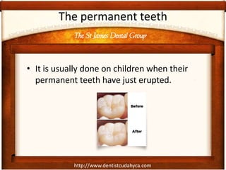 http://www.dentistcudahyca.com
The permanent teeth
• It is usually done on children when their
permanent teeth have just erupted.
The St James Dental Group
 