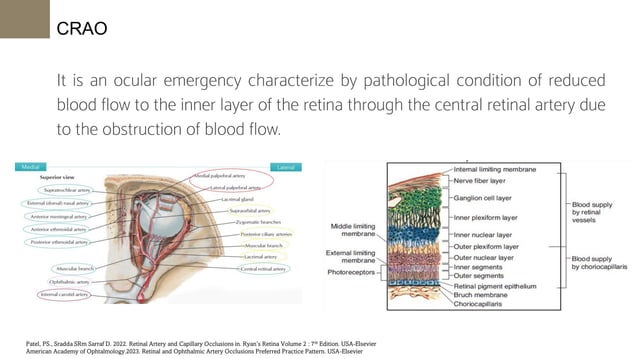 DIAGNOSIS AND MANAGEMENT CENTRAL RETINA L ARTERY OCCLUSION | PDF
