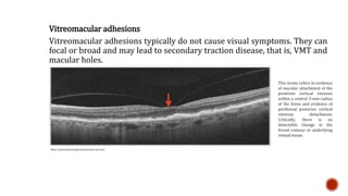 DISEASE OF THE VITREOUS AND VITREORETINAL INTERFACE.pptx