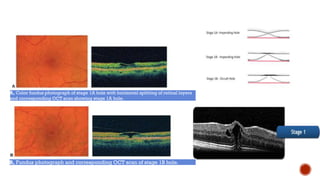 DISEASE OF THE VITREOUS AND VITREORETINAL INTERFACE.pptx