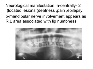Neurological manifestation: a-centrally- 2
(located lesions (deafness ,pain ,epilepsy
b-mandibular nerve involvement appears as
R.L area associated with lip numbness

 