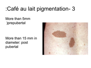 :Café au lait pigmentation- 3
More than 5mm
(prepubertal

More than 15 mm in
diameter: post
pubertal

 