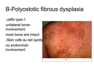 B-Polyostotic fibrous dysplasia
:Jaffe type-1
unilateral boneinvolvement
most bone are intact-Skin café au lait spots
no endocrinalinvolvement

 