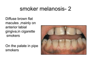 smoker melanosis- 2
Diffuse brown flat
macules ,mainly on
anterior labial
gingiva,in cigarette
smokers
On the palate in pipe
smokers

 