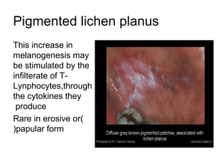 Pigmented lichen planus
This increase in
melanogenesis may
be stimulated by the
infilterate of TLynphocytes,through
the cytokines they
produce
Rare in erosive or)
(papular form

 
