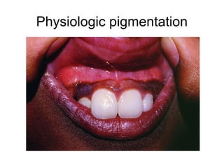 Physiologic pigmentation

 