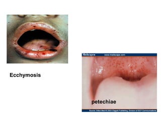 Ecchymosis

petechiae

 