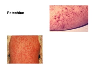 Petechiae

 