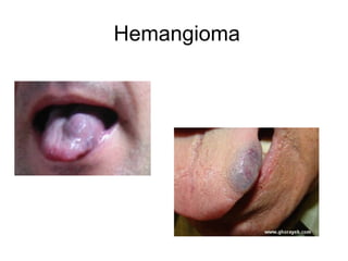 Hemangioma

 