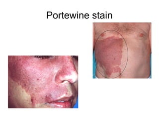 Portewine stain

 