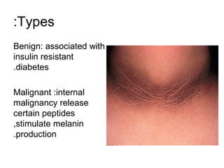 :Types
Benign: associated with
insulin resistant
.diabetes
Malignant :internal
malignancy release
certain peptides
,stimulate melanin
.production

 