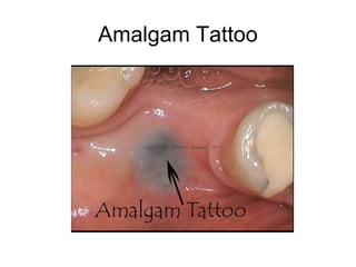 Amalgam Tattoo

 