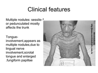 Clinical features
Multiple nodules: sessile-1
or pedunculated mostly
affects the trunk
Tongueinvolvement,appears as
multiple nodules,due to
lingual nerve
involvement,scrotal
tongue and enlarged
.fungiform papillae

 