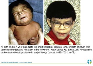 At birth and at 4 yr of age. Note the short palpebral fissures; long, smooth philtrum with 
vermillion border; and hirsutism in the newborn. From Jones KL, Smith DW: Recognition 
of the fetal alcohol syndrome in early infancy, Lancet 2:999–1001, 1973.) 
 