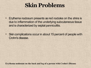 Skin Problems
• Erythema nodosum presents as red nodules on the shins is
due to inflammation of the underlying subcutaneous tissue
and is characterized by septal panniculitis.
• Skin complications occur in about 15 percent of people with
Crohn's disease.
Erythema nodosum on the back and leg of a person with Crohn's Disease
 