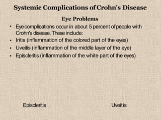 Systemic Complications ofCrohn's Disease
•
•
•
•
Eye Problems
Eyecomplications occur in about 5 percent ofpeople with
Crohn's disease.These include:
Iritis (inflammation of the colored part of the eyes)
Uveitis (inflammation of the middle layer of the eye)
Episcleritis (inflammation of the white part of the eyes)
Episcleritis Uveitis
 